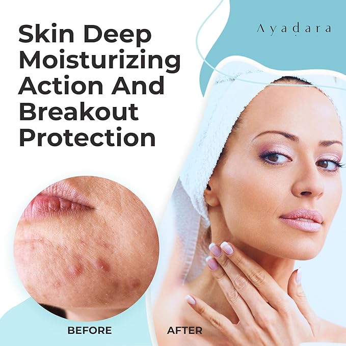 Moisturizing Acne Cream, Salicylic Acid Face Moisturizer for Oily & Acne-Prone Skin, Helps with Pimples, Blackheads, Whiteheads, Hormonal & Cystic Acne, for Men and Women, 90-Day Supply by Ayadara