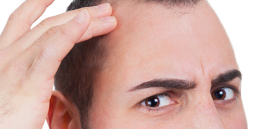 Early Signs of Male Pattern Baldness