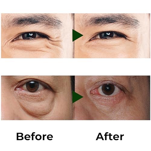 Abera Eye Roller & Essence for Men – Day & Night Treatment for Puffy Eyes & Dark Circles – Under Eye Bags Treatment with Cooling Mint Roller + Anti-Aging Serum