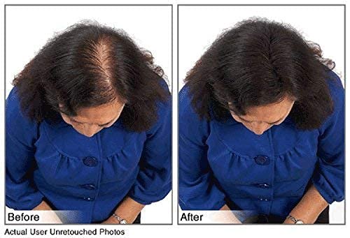 (Black) Hair Building Fibers Instantly Conceal Thinning Hair and Bald Spots for Men & Women (Large 28 Grams Bottle) - Undetectable, Washes Away, For All Hair Types, No Animal Byproducts