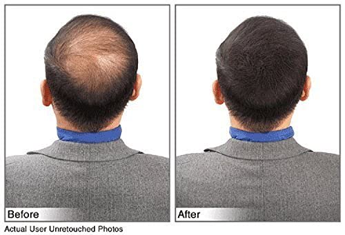 (Black) Hair Building Fibers Instantly Conceal Thinning Hair and Bald Spots for Men & Women (Large 28 Grams Bottle) - Undetectable, Washes Away, For All Hair Types, No Animal Byproducts