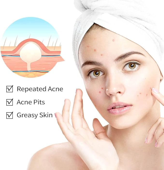 Acne Cream Pimple Cream for Face, Oil Control Pimple Remover Cream Get Rid of Pimples Fast,for Oily and Acne Prone Skin, Cruelty Free, Crema para espinillas en la cara