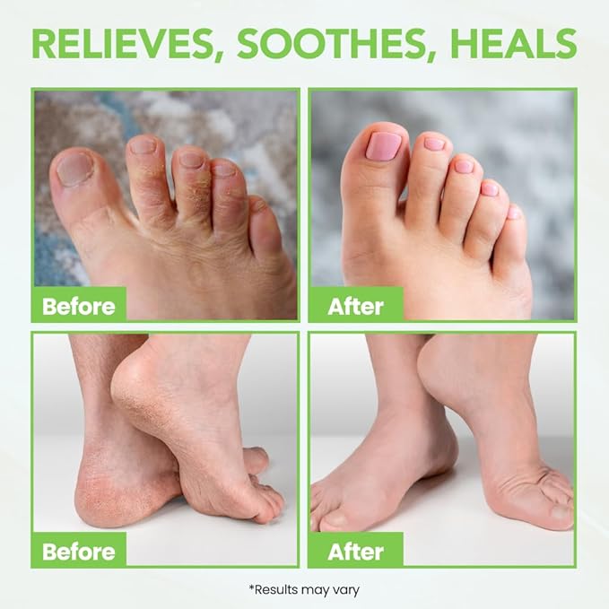 Thena Athletes Foot Cream Extra Strength Herbal Relief with Tea Tree Neem & Menthol, Athletes Foot Treatment Balm for Itchy Dry Cracked Feet, Heels & Toes, Advanced Plant-Based Foot Care