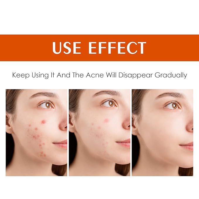 Acne Treatment for Face Hormonal Cystic Stubborn Acne Cream Back Butt Acne Spot Treatment for Teens Adults Moisturizer Pimple Rapid Clearing Cream for Breakouts Blemish Overnight 30g