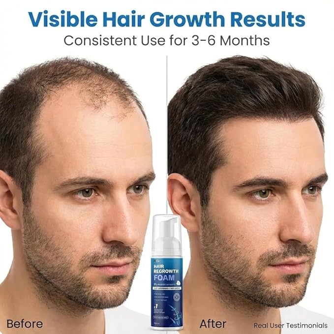 5% Minoxidil Foam for Men, Fast-Absorbing Non-Greasy Hair Regrowth Treatment for Thinning Hair & Beard, Clinically Proven, 2 x 2.11 Oz (2 Month Supply)