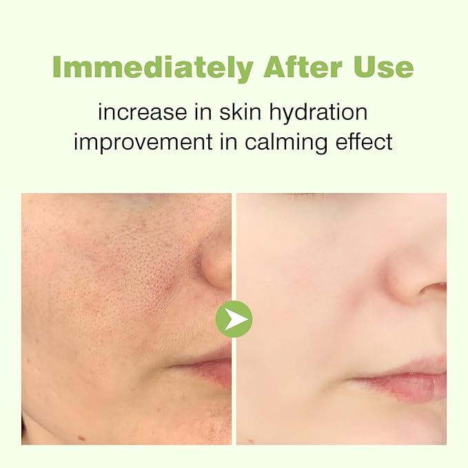 345 Relief Cream, Moisturizer for Acne Scar Recovery with PDRN Niacinamide, Face Acne Cream Treatment for Acne-Prone Scar Skin, Facial Moisturizer for All Skin Women Men - 1.69 floz