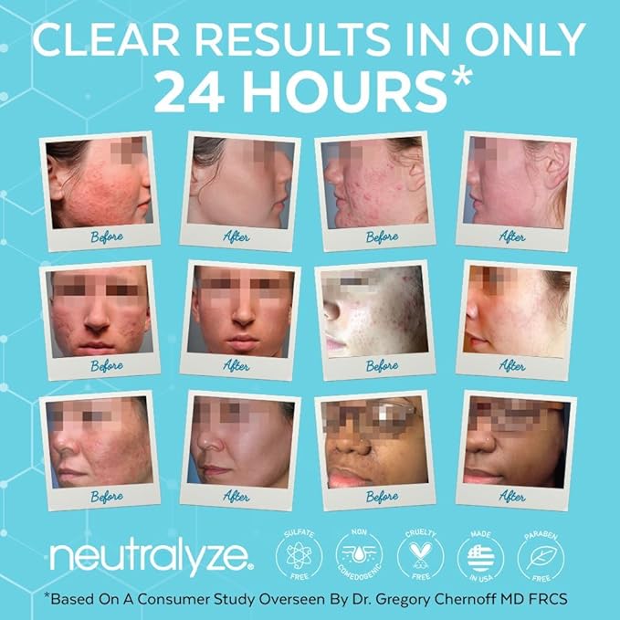 Neutralyze Renewal Complex Acne Moisturizer for Face - Maximum Strength, Time Released 2% Mandelic Acid & 2% Salicylic Acid Acne Treatment Cream - Suitable for All Skin Types, Teens & Adults