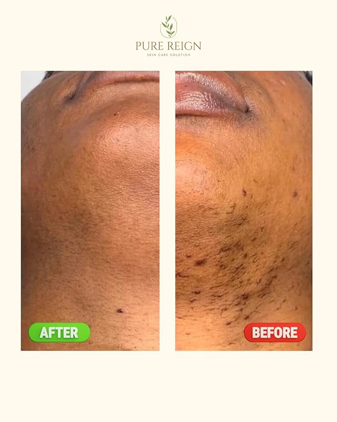 Skin Care Solution | Ingrown Hairs, Razor Bumps, Shaving/Waxing 5oz (150ml)