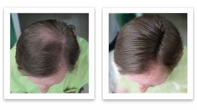 Caboki Hair Building Fiber + Built-in Spray Applicator (30-50 Days Supply). Medium Brown