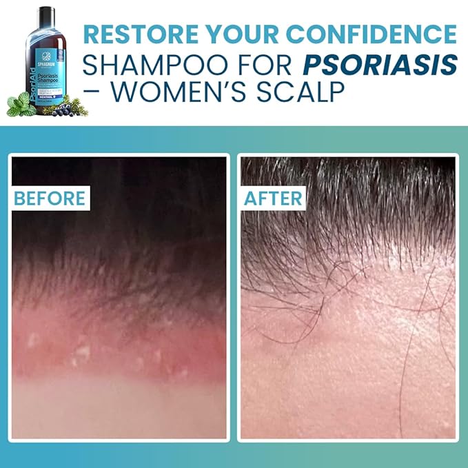 Sphagnum Botanicals Psoriasis Shampoo with Salicylic Acid - Natural Scalp Support for Dry, Itchy, Flaky Scalp with Menthol & Peat Mud – Sulfate-Free, Gentle Formula – 13.5 fl oz