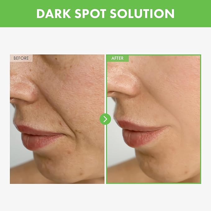 TOSOWOONG Kakadu Plum Blemish Cream, Dark Spot Remover for Face Cream, Kakadu Plum 600,000ppm, Niacinamide, Adenosine, Betaine, Dark Spot Corrector, Vitamin C, Korean Skin Care, 50g, 1.76 oz.