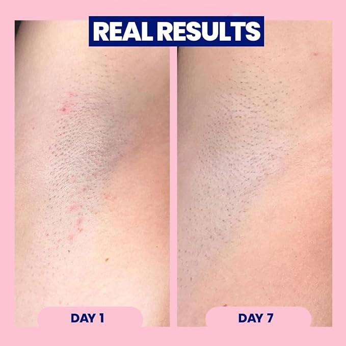Megababe Après Shave | Post-Shave & Waxing | Ingrown Hair & Razor Bump Roll-On Treatment for Women | Bikini, Armpits & Legs (1.7 fl oz)