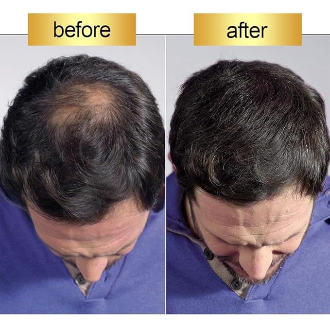 Hair Building Fibers Black 27.5g – Instant Hair Thickener for Men & Women – Conceals Thinning Hair & Bald Spots – Hair Loss Concealer Powder for Fuller, Natural-Looking Thick Hair Fiber 0.97oz