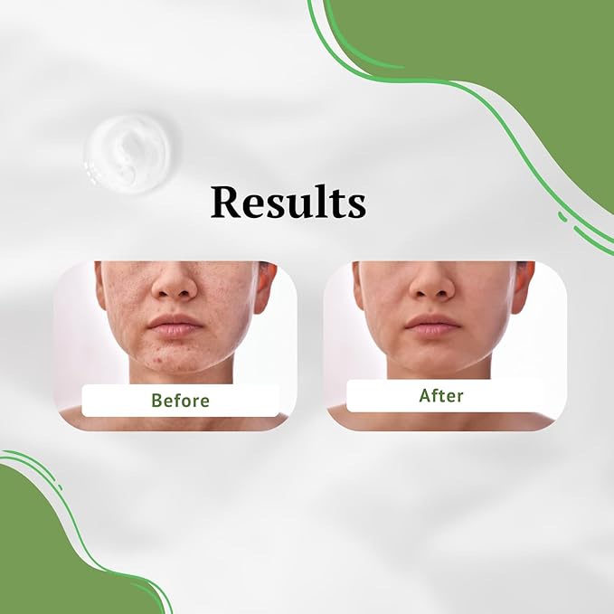 Aloe Vera Gel Cleanser, For Dry & Oily Skin. Treat & Prevent Acne, Dark Spots & Eczema. Face Wash for Men and Women.