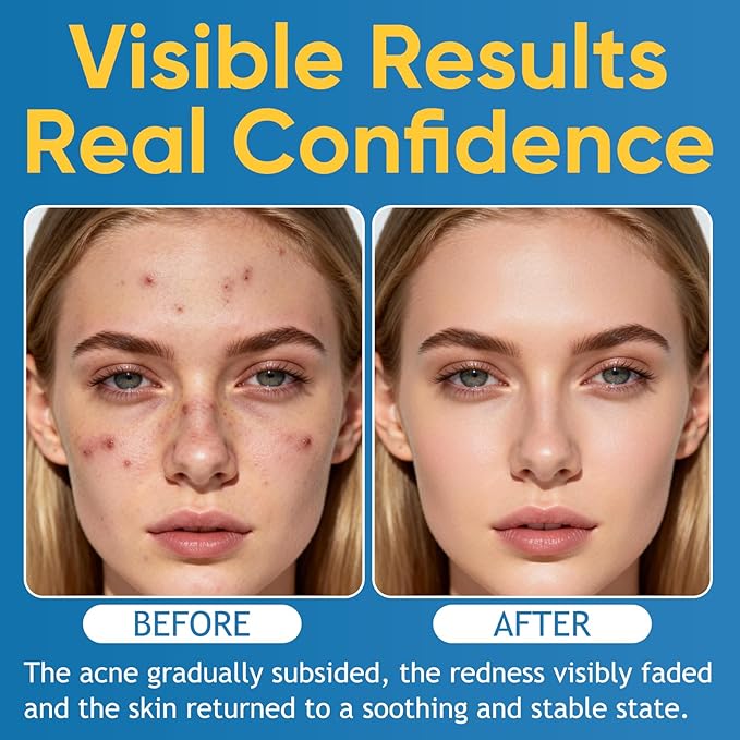 2PCS Acne & Redness Killer, Acne Set for Healthy Skin, Facial Cream With Marigold, Thistle, Lavender, Beeswax, Sea Buckthorn, Vitamin E - For All Skin Types Men & Women