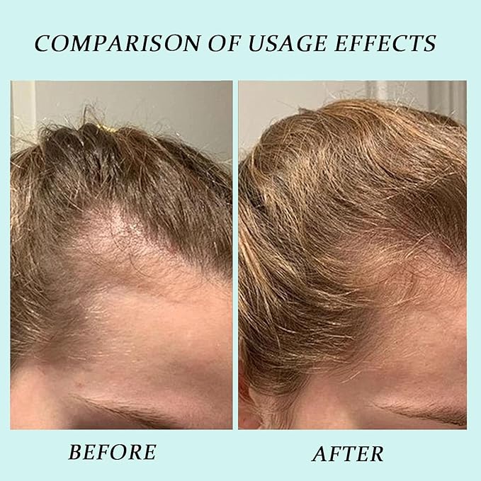 Hair Regrowth Serum, Advanced Scalp Treatment for Thicker, Fuller Hair, Reduces Shedding & Revitalizes Follicles, for Men & Women, 2 fl oz (1pcs)