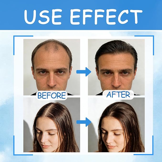 5% Minoxidil for Men, Minoxidil for Women Hair Growth, 2 Fl Oz (60ml) Minoxidil 5% Hair Regrowth Treatments, Minoxidil Spray for Thinning and Loss, Yellow and Blue