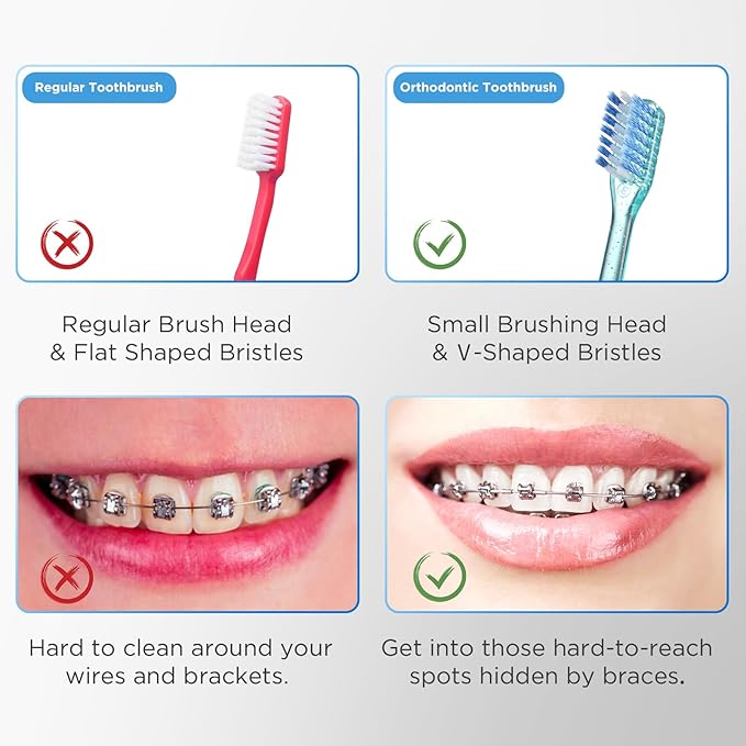 Fregum V-Shaped Orthodontic Toothbrush for Braces, Soft Bristles, 6 Count, No Interdental Brushes Included