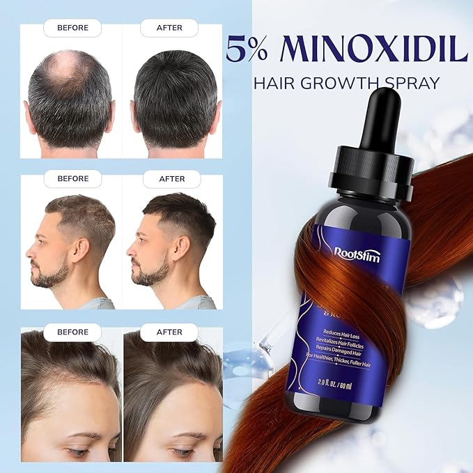 5% Minoxidil Hair Growth Kit for Men and Women: Extra Strength Minoxidil Hair Loss Treatment Serum with Rosemary for Faster Stronger Thicker Hair Growth - 60ML