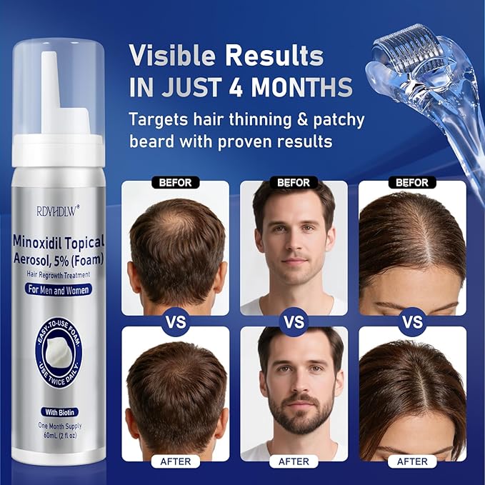 5% Minoxidil Foam for Men and Women Hair Growth, Minoxidil for Men Foam for Hair and Beard, Hair Regrowth Treatment Helps Regrow Hair Loss & Thinning (7pcs, 14.77oz, 7 Month Supply)