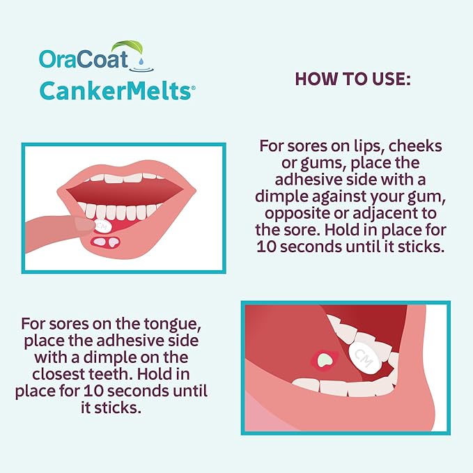 Oracoat CankerMelts Stick-On Melts Canker Sore Treatment for Mouth Sores with 15mg Benzocaine, Hyaluronic Acid & Vitamin E
