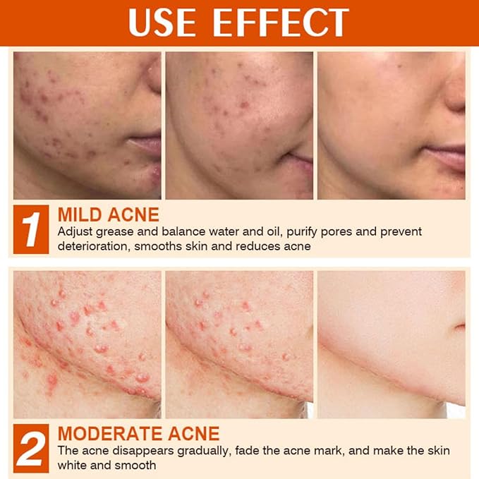Acne Cream Pimple Cream for Face, Oil Control Pimple Remover Cream Get Rid of Pimples Fast,for Oily and Acne Prone Skin, Cruelty Free, Crema para espinillas en la cara