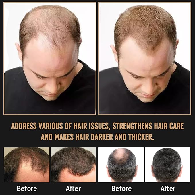 2Pcs Root Activator Shampoo - Hair Growth Root Activator Shampoo for Men and Women - Natural Formula for Hair Loss and Thinning Hair