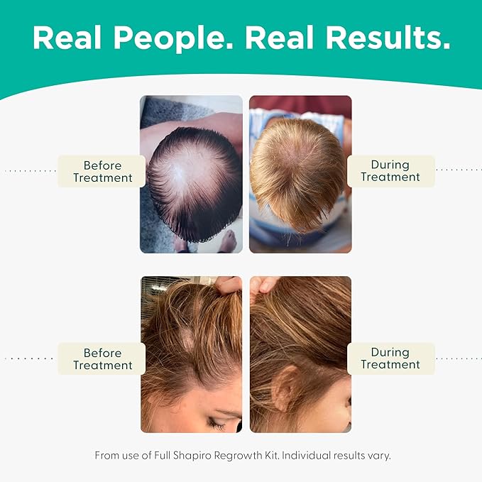 Shapiro MD Hair Growth Experts Hair Loss Leave-in Conditioner, DHT Fighting Vegan Formula for Thinning Hair Developed by Dermatologists, Experience Healthier, Fuller Thicker Hair - 1 Month Supply