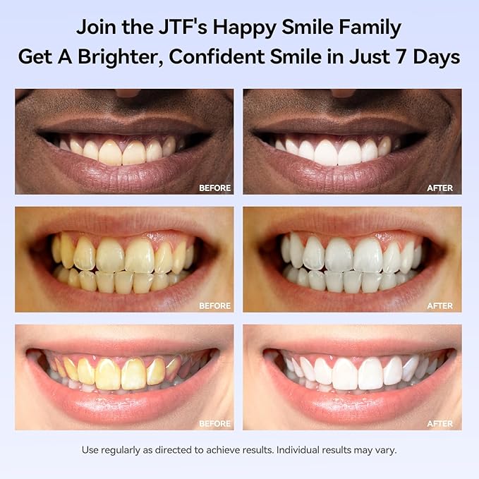 JTF Teeth Whitening Gel Kit: 35% Carbamide Peroxide Removes Stains from Coffee, Wine & Smoking, Safe for Sensitive Teeth & Gentle on Enamel - with 5 Whitening Gels and 1 Remineralization Gel, Mint
