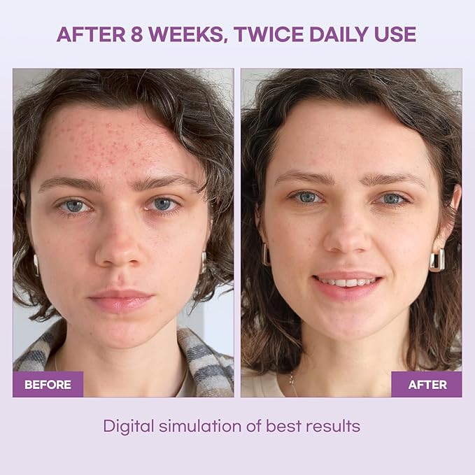 Natural Vine Dark Spot Serum: Dark Spot Remover for Face - Dark Spot Corrector with Grape Extract Fermentation Complex Hyaluronic Acid Vitamin E for Brighter Even Skin Tone 1 FL OZ