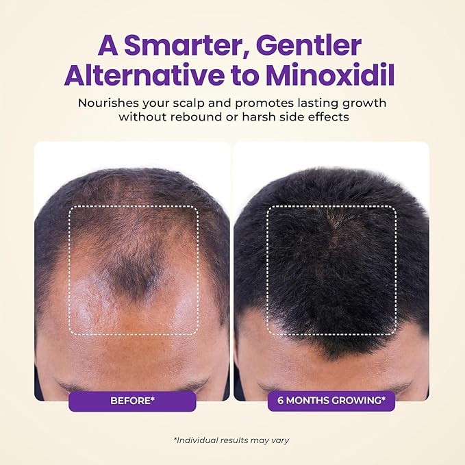 Hair Growth & Thickening Serum With Biotin & Rosemary + Multi-Benefit Treatment for Thinning Hair, Breakage & Split Ends, Boosts Density, Repairs Damage, Hydrates Dry Scalp - For Men and Women, 3 Pack