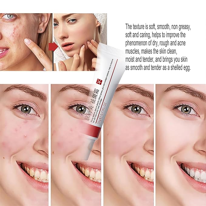 Generic Crema para Manchas Oscuras en La Cara, Dark Spot Remover for Face, Freckles Melasma Brown Spot Corrector for Men Women, Crema para Las Manchas de La Cara 20G