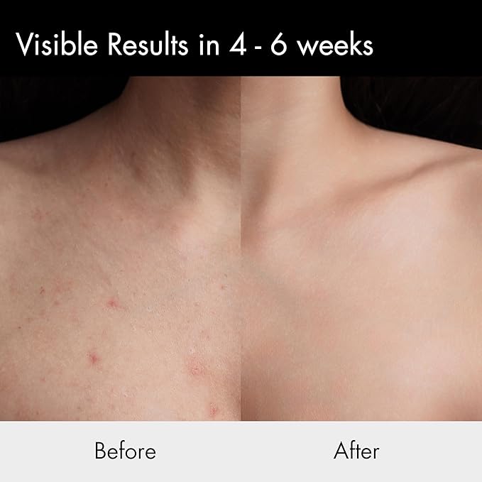 Acne Body Spray for Back & Chest – Exfoliating Body Mist for Breakouts & Blemishes – Daily Clarifying Spray for Men & Women