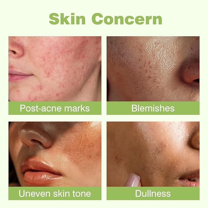 345 Relief Cream, Moisturizer for Acne Scar Recovery with PDRN Niacinamide, Face Acne Cream Treatment for Acne-Prone Scar Skin, Facial Moisturizer for All Skin Women Men - 1.69 floz