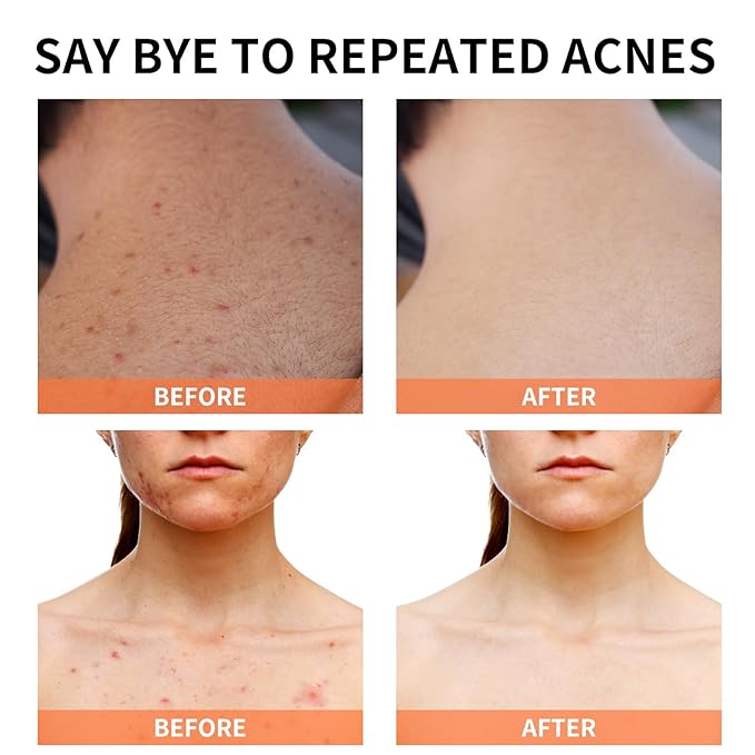 Acne Treatment for Face for Hormonal Cystic Stubborn Acne Cream for Sensitive Skin Teens Adults Women Men Spot Pimple Butt Control Rapid Clearing Breakout Overnight Face Blemish Treatment