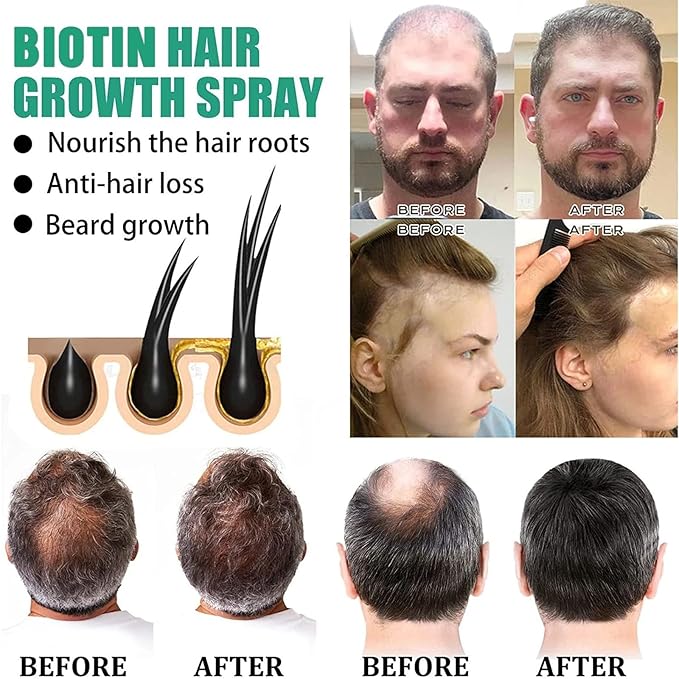 Biotin Hair Growth Serum，Hair Growth Spray Containing Ginseng Root Extract and Ginger Root Extract，Moisturizes the scalp, strengthens hair follicles, prevents hair loss, and promotes hair growth.
