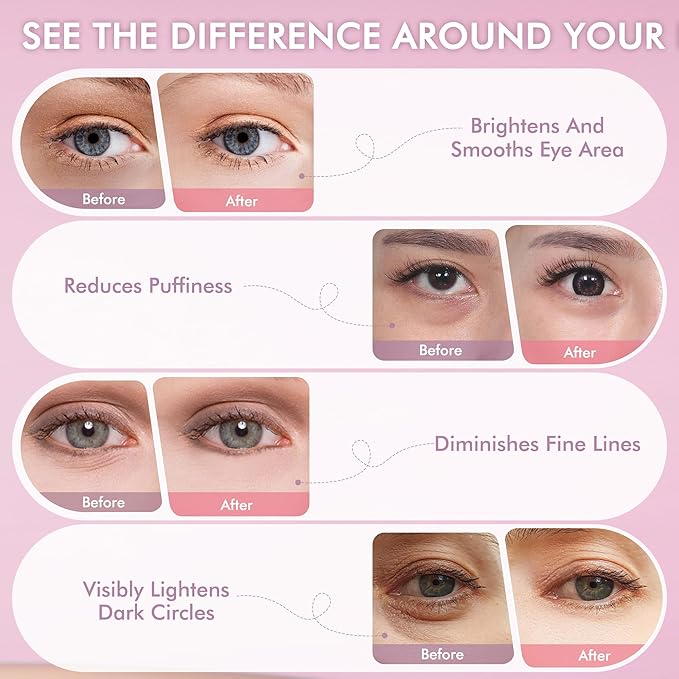 Under Eyes Patches, 40 Pairs Rose Hydrogel Eye Mask for Puffy Eyes and Dark Circles with Rose Essence, Hyaluronic Acid & Niacinamide, Deep Hydrating Eye Treatment for Men & Women
