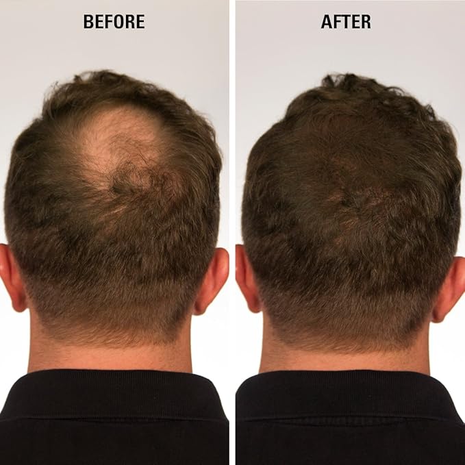 ECLIPSE Hair Fibers Auburn for Thinning Hair for Women & Men to Conceal Hair Loss in 15 Seconds - 100% Undetectable Hair Building Fibers, 30g