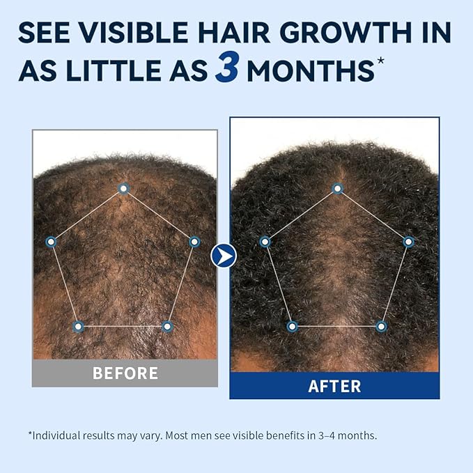 5% Minoxidil for Men Hair Growth Spray, Extra Strength Hair Regrowth Treatment for Men to Combat Hair Loss and Thinning