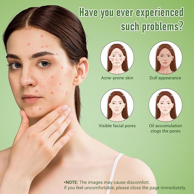 14% Azelaic Acid Acne Cream, Azelaic Acid For Face, Helps Improve the Appearance of Acnes - Azalecic Acids Acido Azelaico, 1 Fl Oz