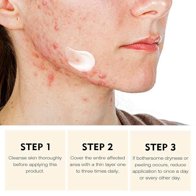 Acne Treatment for Face Hormonal Cystic Stubborn Acne Cream Back Butt Acne Spot Treatment for Teens Adults Moisturizer Pimple Rapid Clearing Cream for Breakouts Blemish Overnight 30g