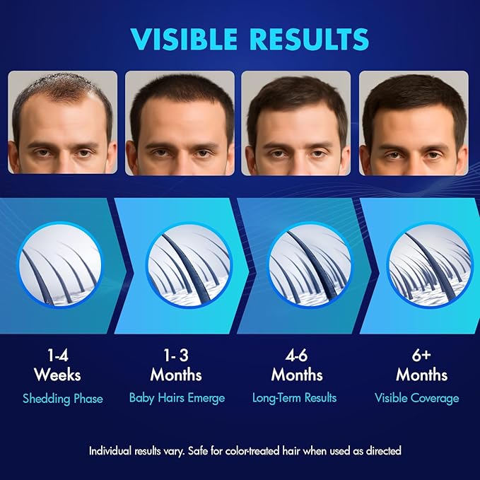5% Minoxidil Hair Growth for Men and Women: Extra Strength Minoxidil Topical Solution for Adults with Receding Hairlines or Vertex Thinning - Hair Loss Treatment Serum with Biotin for Daily Scalp Use
