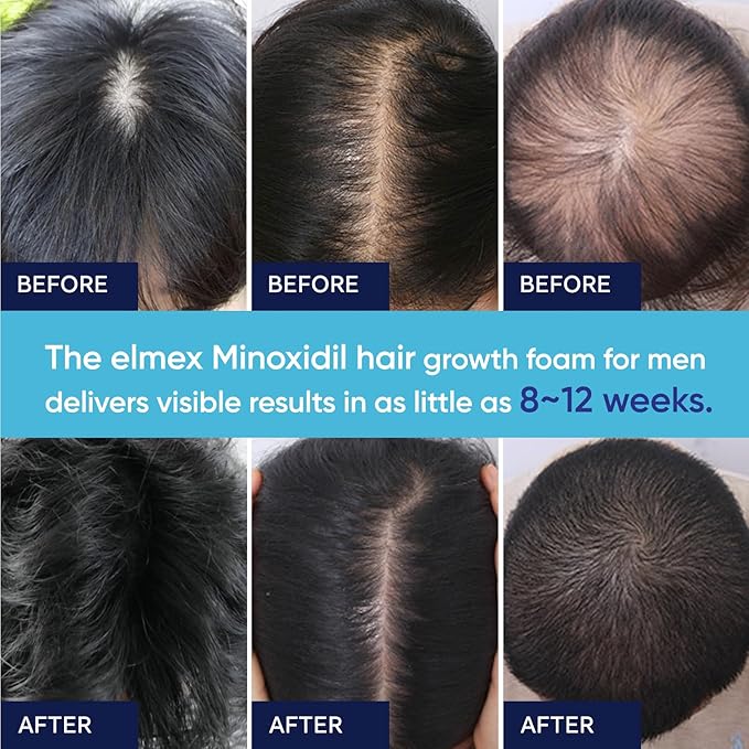 5% Minoxidil Foam for Men and Women, Minoxidil for Men Foam for Hair and Beard, Minoxidil for Women Hair Growth (2 Ounce)