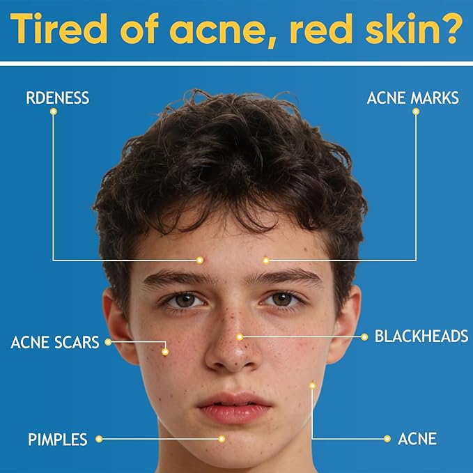 2PCS Acne & Redness Killer, Acne Set for Healthy Skin, Facial Cream With Marigold, Thistle, Lavender, Beeswax, Sea Buckthorn, Vitamin E - For All Skin Types Men & Women