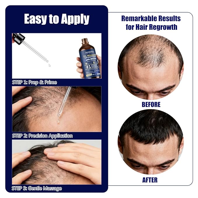 5% Minoxidil for Men Hair Growth with Biotin, 100ML Topical Minoxidil Solution Serum with Rosemary & Caffeine for Hair Regrowth Treatments, Non-Greasy, Helps Prevent Hair Thinning & Hair Loss