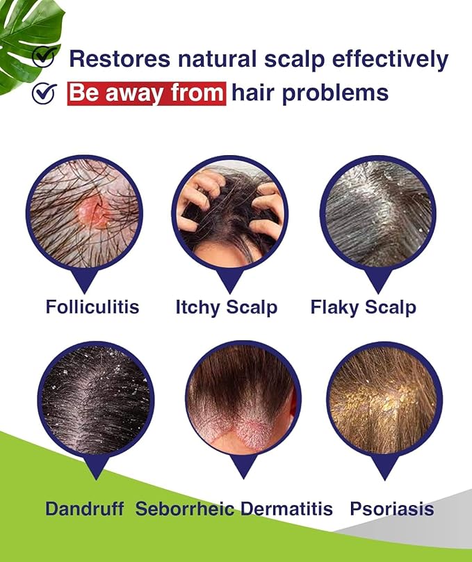 Anti-Fungal Shampoo for Itchy, Dry Scalp – Supports Scalp Health, Helps with Folliculitis, Seborrheic Dermatitis & Scalp Flaking-2 Pack