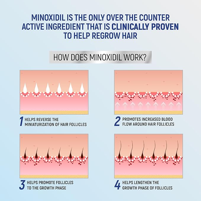 Minoxidil Topical Aerosol Foam, 5%, Hair Regrowth 4 Months Treatment for Men, 2.11 oz (4 Pack)