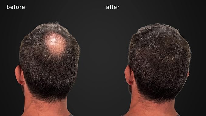 Hair Building Fibers - Volumizing Hair Fibers with real Keratin for Thinning Hair/Hair Loss Dermatologist Tested and Certified Hypoallergenic - 60 days + supply (Medium Brown)