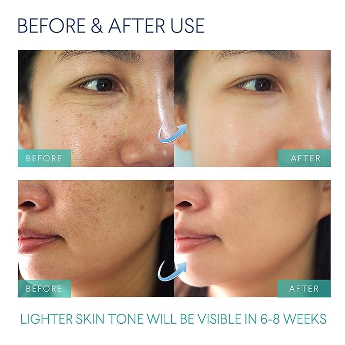 Razor Bumps Treatment for Women and Men, Ingrown Hair Treatment, Razor Bump Treatment for Bikini Area, Face, Neck, Legs, and Underarm Area, After Shave for Women and Men, Ingrown Hair Serum