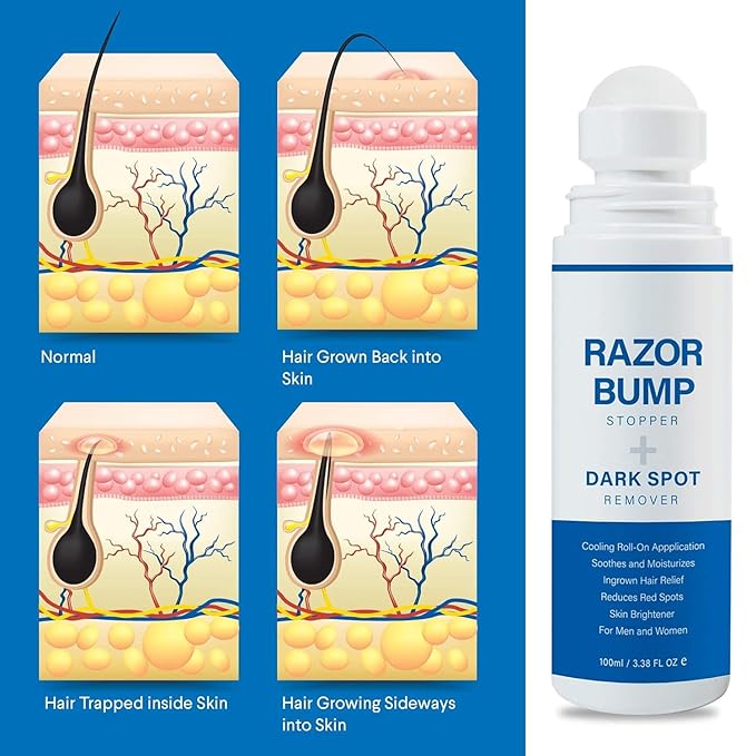 Razor Bump Stopper with Ingrown Hair Treatment: Razor Bumps Treatment for Men and Women, After Shave Solution for Ingrown Hairs and Razor Burns, Roll on Applicator - 3.38 Fl Oz (Pack of 2)